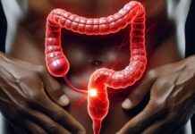 Campaña de prevención del cáncer de colon y recto alcanza nuevo récord campaa-de-prevencin-del-cncer-de-colon-y-recto-alcanza-nuevo-rcord